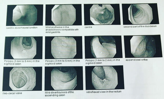 大腸内視鏡検査